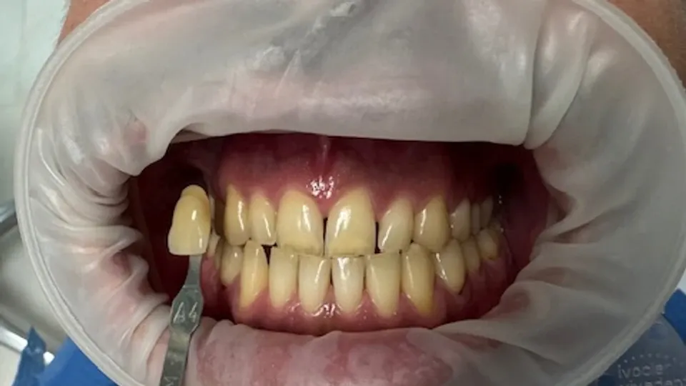 Vista frontal de la dentadura antes del blanqueamiento junto a una guía de color A4
