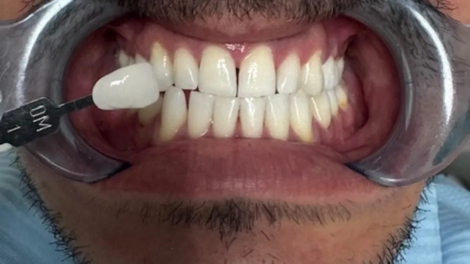 Vista frontal de la misma dentadura después del blanqueamiento dental