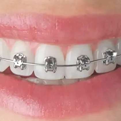 Dentadura con brackets de ortodoncia fija