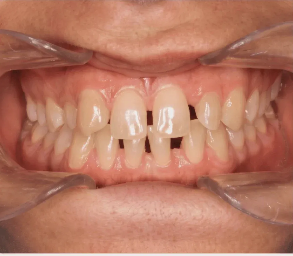 Sonrisa antes del tratamiento, con dientes desgastados y espacios entre ellos