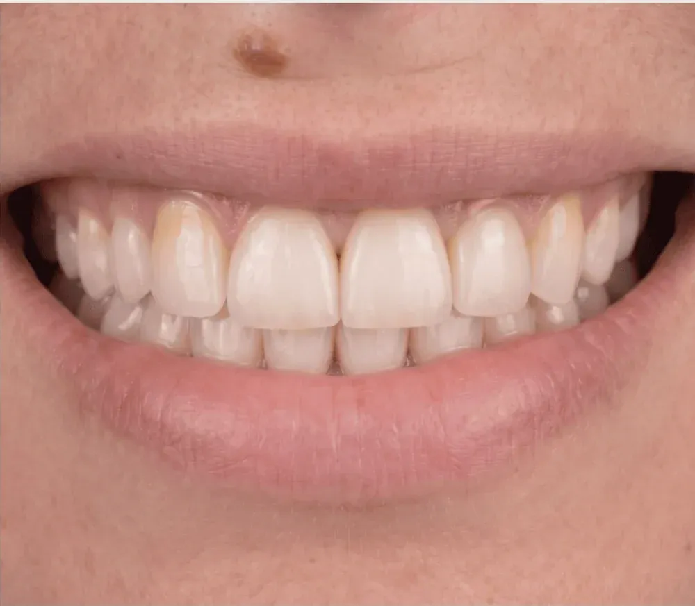 La misma sonrisa después de colocar carillas dentales, alineada y uniforme