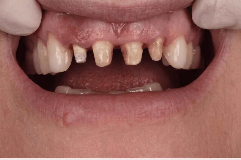 Dentadura antes del tratamiento, con dientes fracturados y desgastados