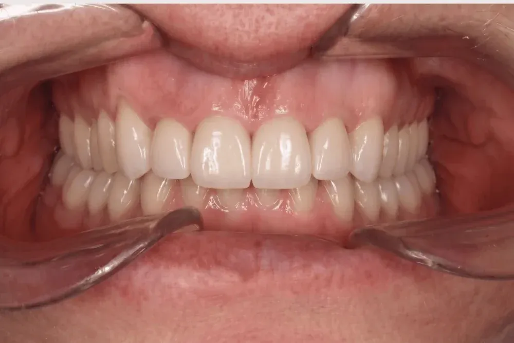 La misma boca después de colocar coronas estéticas, con dientes completos y uniformes