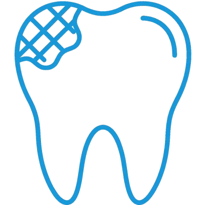 Ilustración de una restauración dental con composite