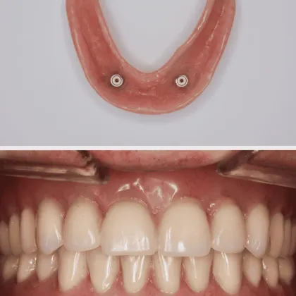 Sobredentadura con ataches sobre implantes dentales