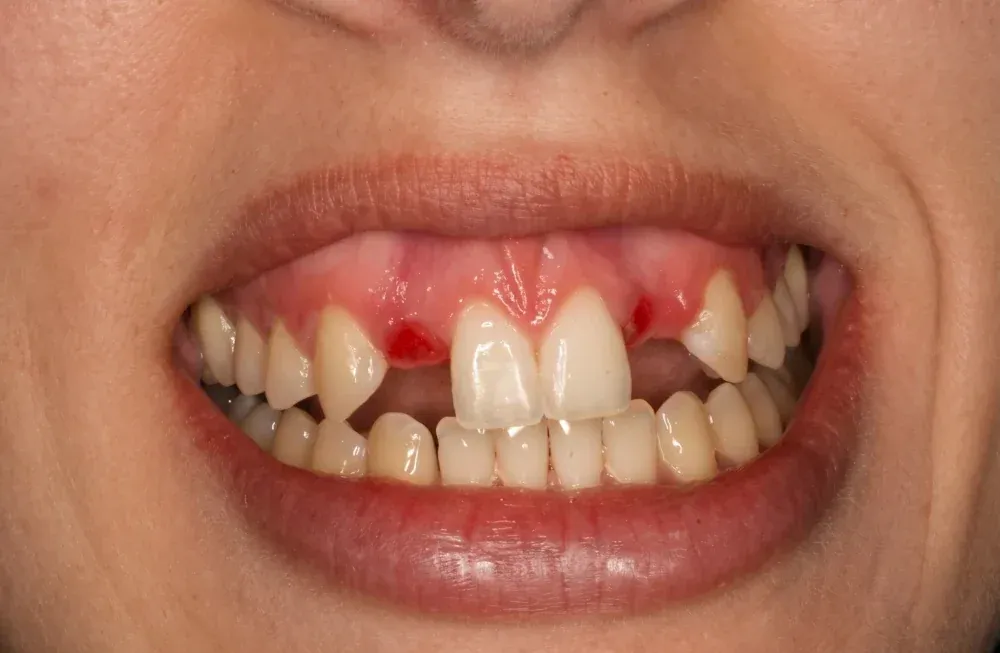 Sonrisa con la ausencia de un incisivo antes del tratamiento