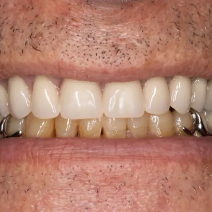 Prótesis dental removible