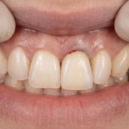 Ilustración de regeneración ósea tras una extracción dental